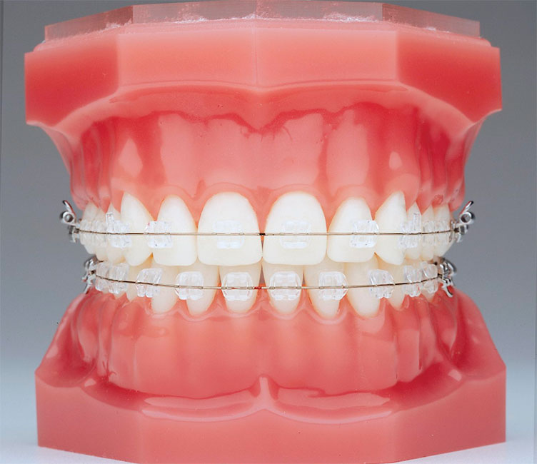 Sapfirovie Ormco השראה ICE